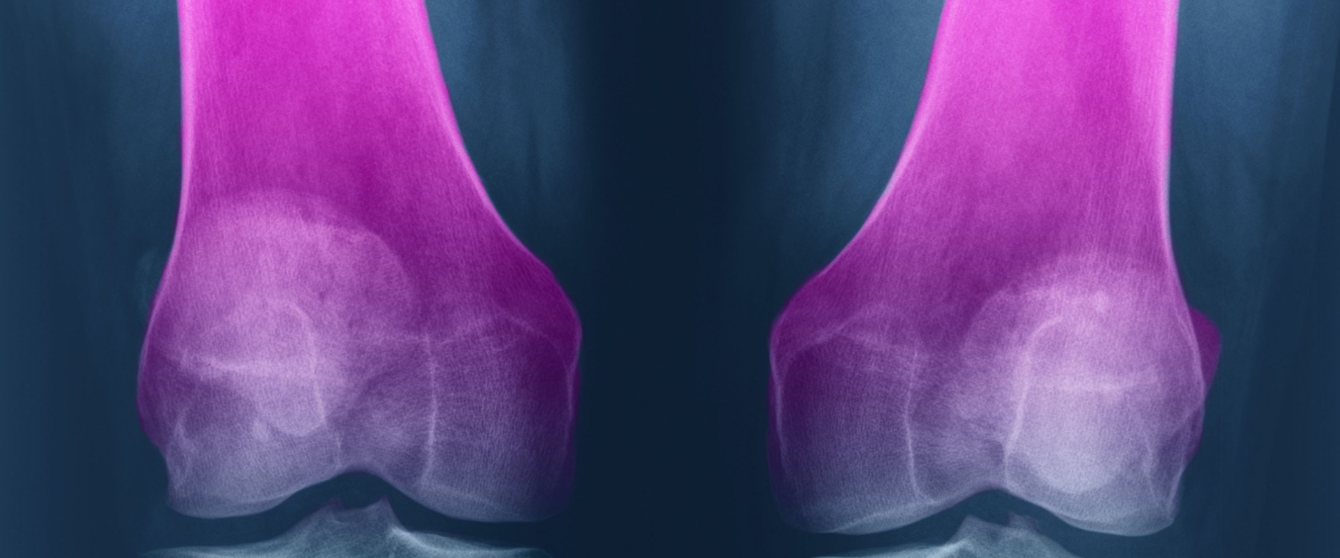 Does Glucosamine Really Help with Osteoarthritis?
