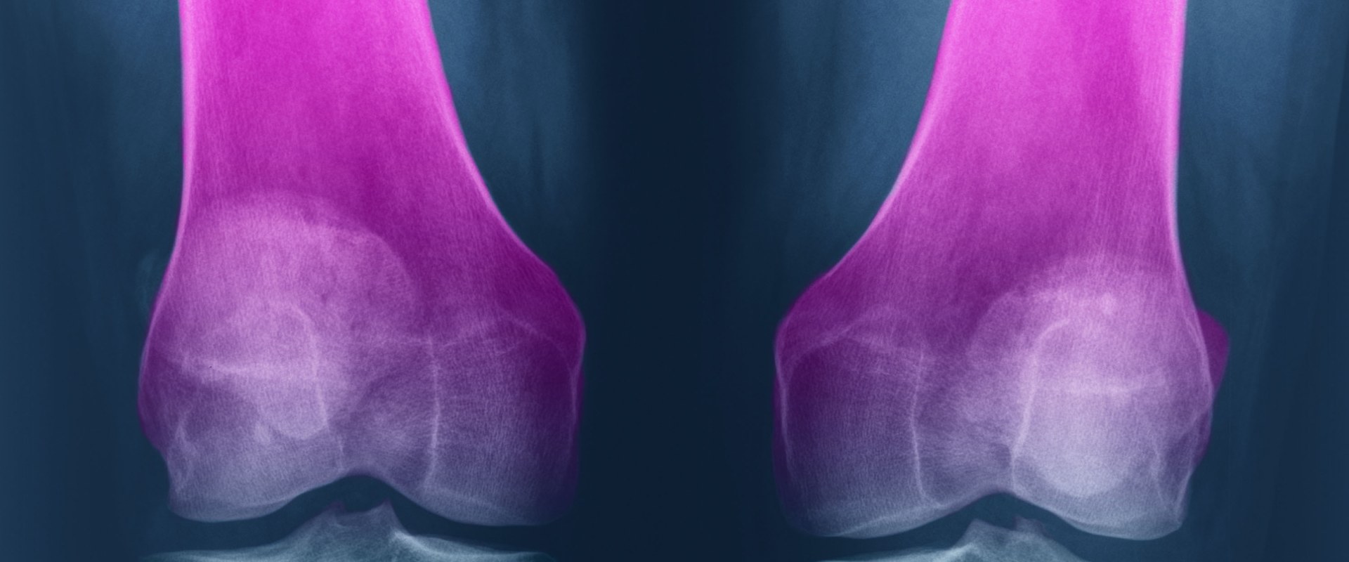 Can Glucosamine Chondroitin Help Rebuild Cartilage?