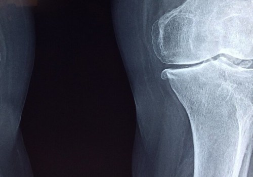 Regenerating Cartilage: What Are Your Options?