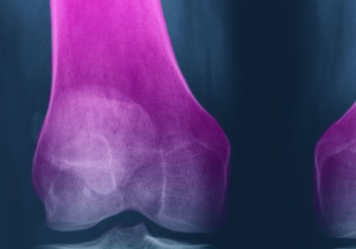 Does Glucosamine Really Help with Osteoarthritis?